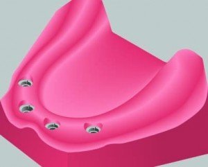 implantdentures