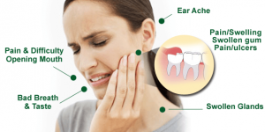 impacted-wisdom-teeth-pain-martin-dubois-gatineau-ottawa